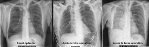 Radiographies des poumons
