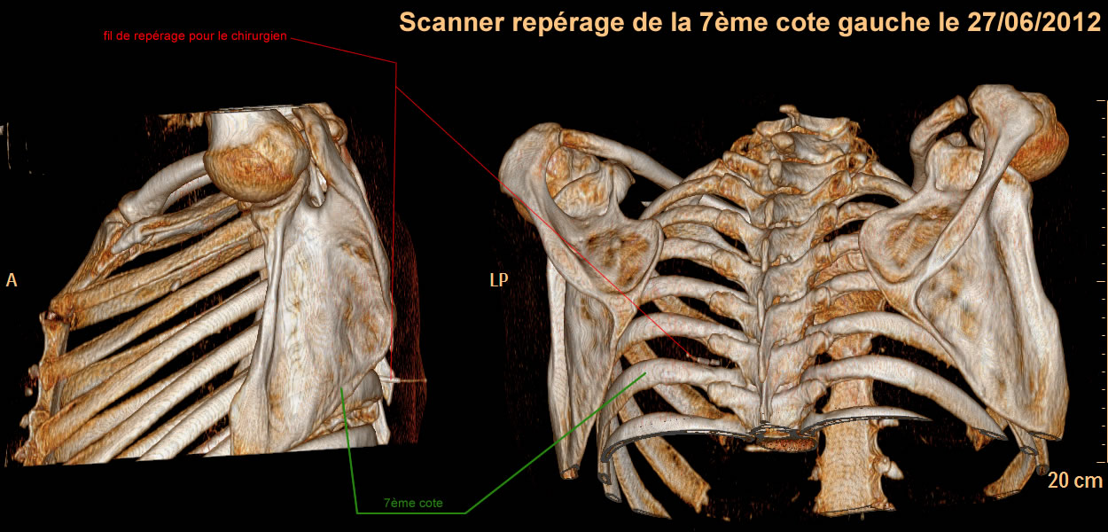 Diagnostic De La Maladie Philippeau eu