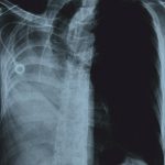 Radiographie, 3 ans et demie de rémission