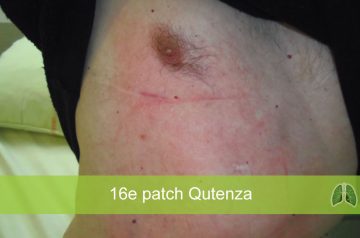 patch Qutenza (16)