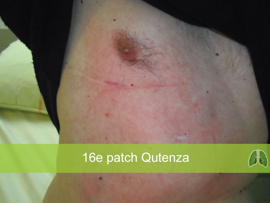 patch Qutenza (16)