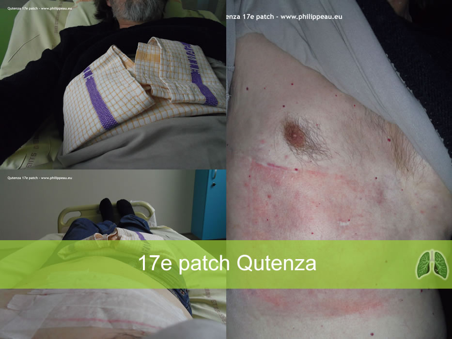 Qutenza 17e patch