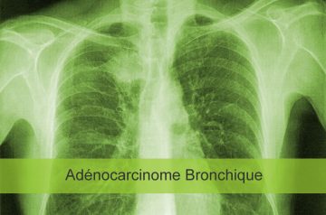 Adénocarcinome bronchique