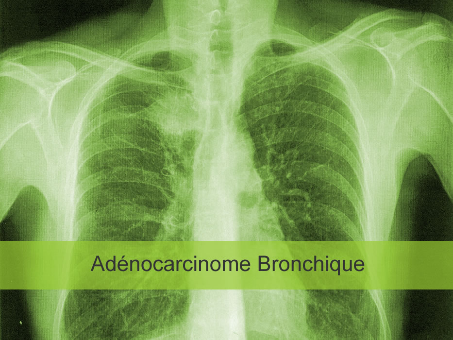 Adénocarcinome bronchique