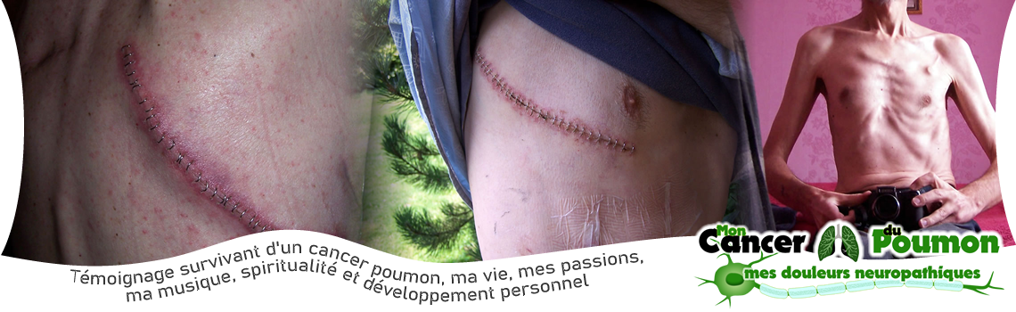 Lobectomie - Pneumonectomie - 50 kg après chimio