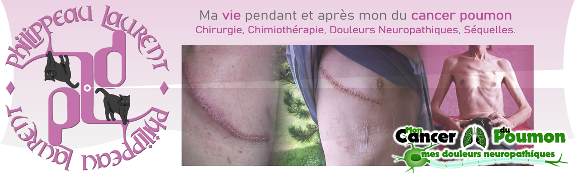 Mon témoignage cancer poumon